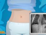 Operate Now! Scoliosis Surgery